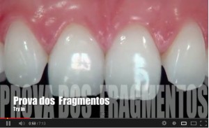 videofacetas_dentistacuritiba_estetica