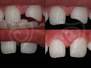 Fragmento ceramico, dentista Curitiba Albano Buen